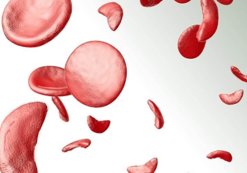 Difference Between Sickle Cell Anemia and Disease: Learn the Hidden Variants and How Each Impacts Diagnosis and Treatment